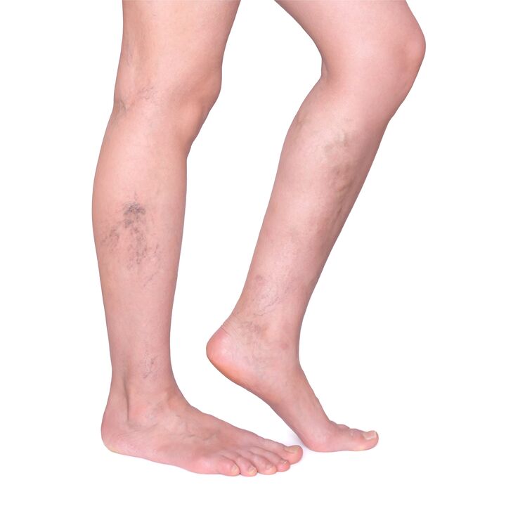 indications for Neoveris - swollen and tortuous veins in the legs